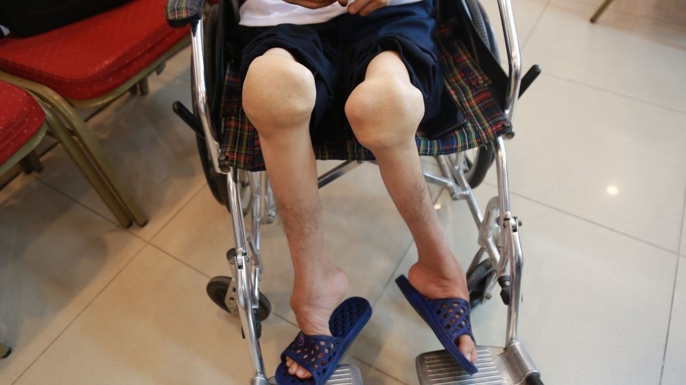 Căn bệnh "lạ": Sau nhiều lần ngã bầm tím thì chân tay teo tóp, biến dạng