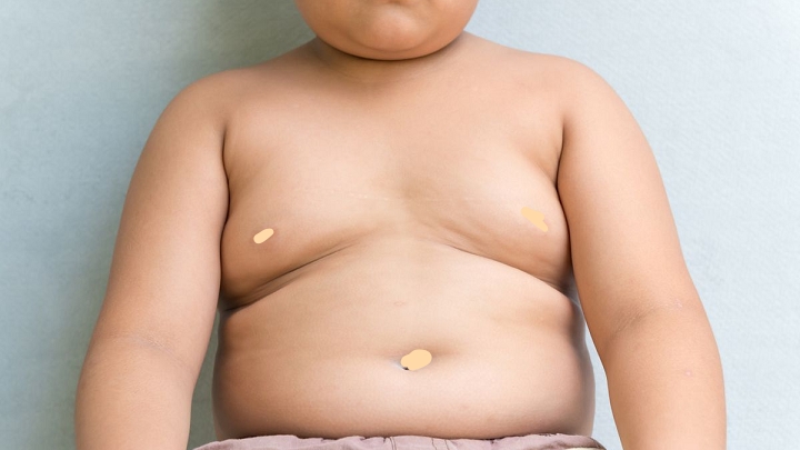 Thừa cân-béo phì ở trẻ là nguy cơ mắc các bệnh mãn tính khi trưởng thành