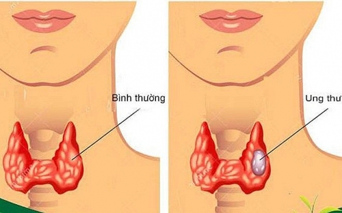 Triệu chứng ung thư tuyến giáp giai đoạn đầu