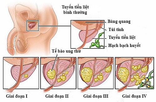 Dấu hiệu nhận biết ung thư tuyến tiền liệt