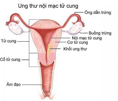 Dấu hiệu nhận biết ung thư nội mạc tử cung