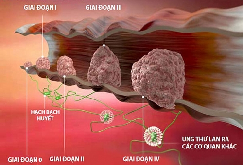 Dấu hiệu nhận biết ung thư đại trực tràng