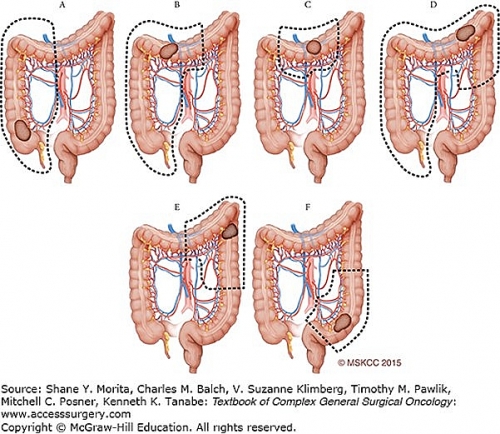 Dấu hiệu nhận biết ung thư đại tràng