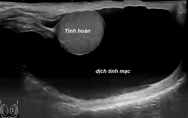 Dấu hiệu nhận biết tràn dịch màng tinh hoàn