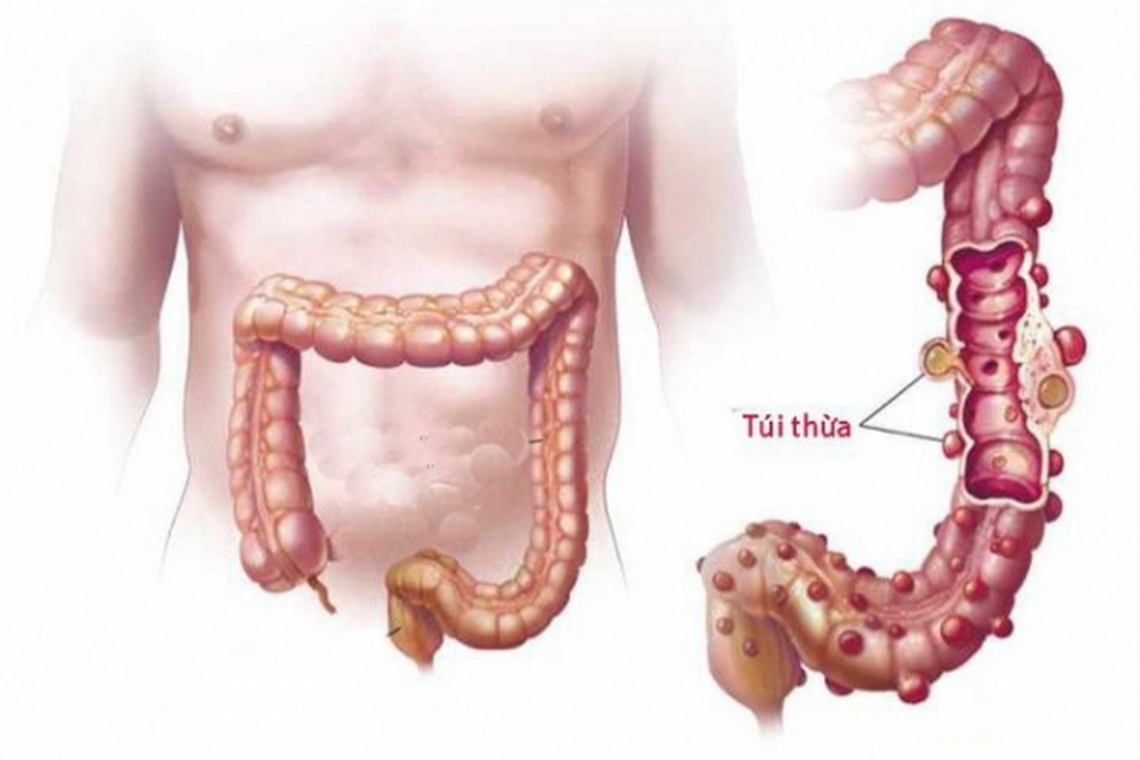 Bệnh túi thừa đại tràng