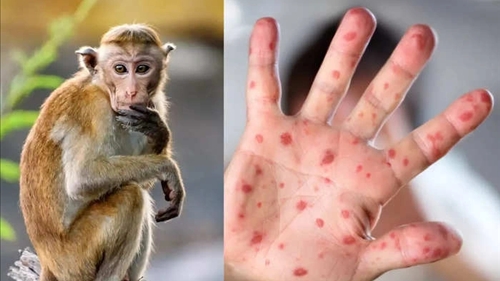Bệnh đậu mùa khỉ có nguy cơ lây lan mạnh vào mùa Hè