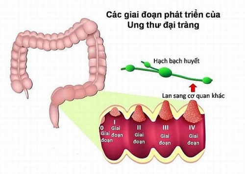 Yếu tố làm tăng nguy cơ mắc ung thư đại trực tràng và cách phòng bệnh