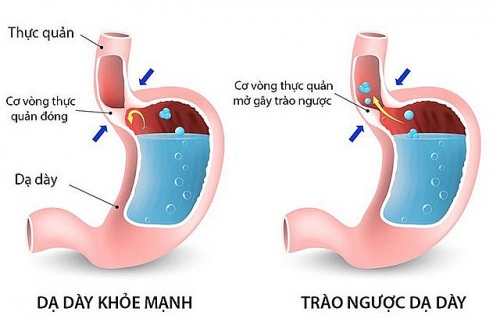 Dấu hiệu nhận biết trào ngược dạ dày thực quản và nguyên nhân gây bệnh