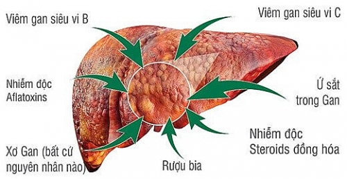 Ung thư gan nguyên phát: Triệu chứng và các yếu tố nguy cơ gây bệnh