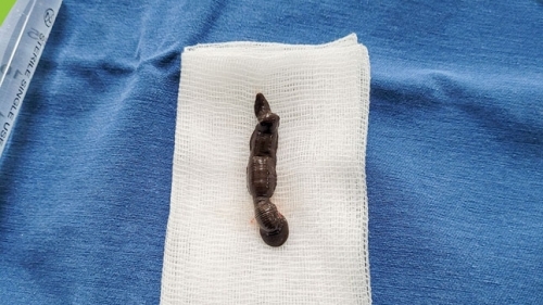 Con đỉa dài 4cm chui sâu vào khí quản bé trai 4 tuổi