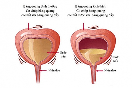 Dấu hiệu nhân biết viêm bàng quang kích thích