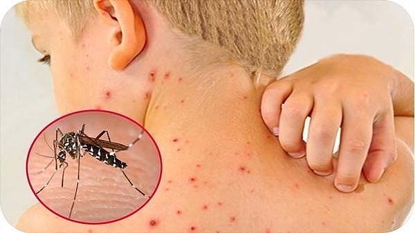 Tỷ lệ mắc mới sốt xuất huyết Dengue tăng trên 30 lần, WHO đưa ra các dấu hiệu cảnh báo bệnh nặng