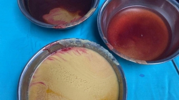 Hút ra hơn 1 lít dịch lỏng từ khối 'ngực khủng' của nữ Việt kiều