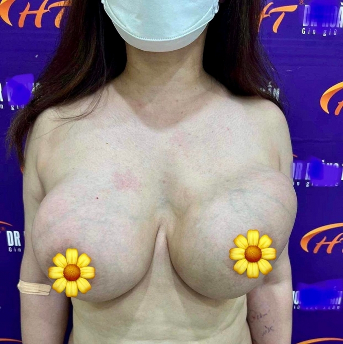 Hút ra hơn 1 lít dịch lỏng từ khối 'ngực khủng' của nữ Việt kiều