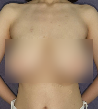 Cô gái 22 tuổi gù lưng vì phải đeo ngực khủng Cô gái 22 tuổi gù lưng vì phải đeo ngực khủng