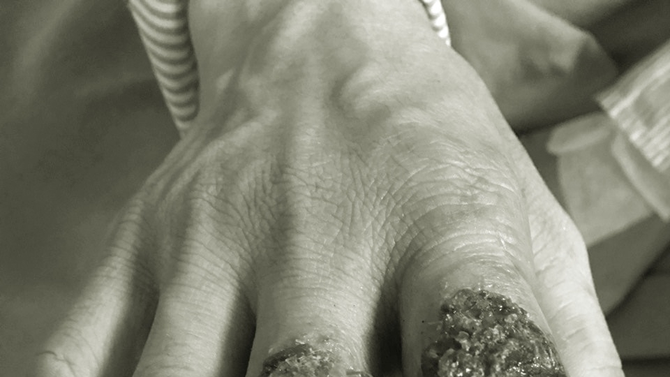 Thêm trường hợp lở loét, nhiễm trùng bàn tay do dùng lá thuốc chữa bỏng