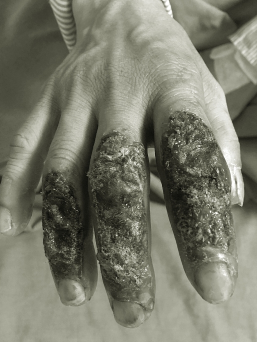 Thêm trường hợp lở loét, nhiễm trùng bàn tay do dùng lá thuốc chữa bỏng