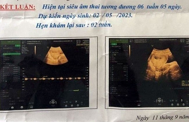 Kết quả siêu âm cho thấy nạn nhân đã mang thai hơn một tháng (Ảnh: Gia đình cung cấp).