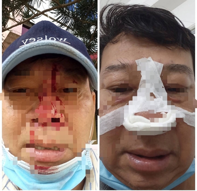   Ông Xuân bị đánh gãy sống mũi nên phải chuyển đến bệnh viện Đa khoa tỉnh Phú Yên điều trị.