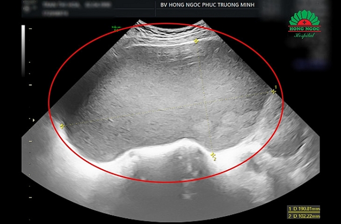 Hình ảnh siêu âm phát hiện khối u nang buồng trứng 18cm x 20cm của chị H.