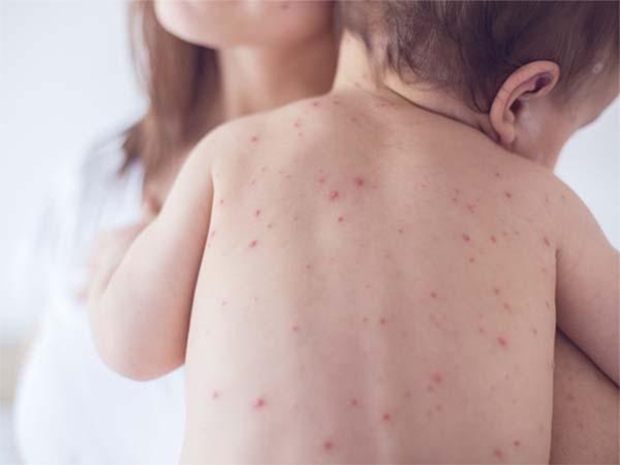 Phân bổ 200.000 liều vắc-xin sởi để tiêm chủng mở rộng cho trẻ em trước nguy cơ bùng dịch