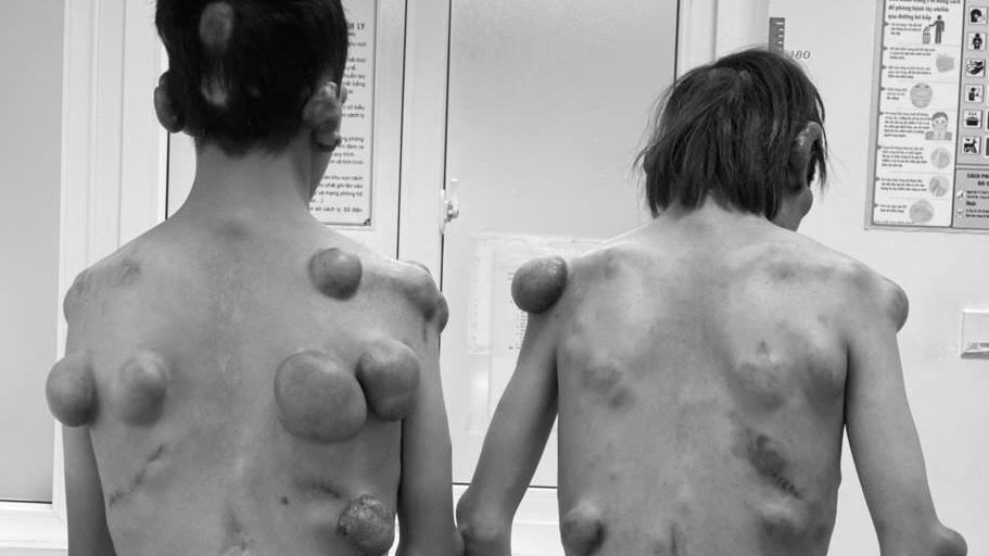 Căn bệnh khiến hai anh em sinh đôi “cõng” hàng trăm khối u trên cơ thể