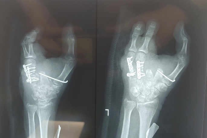 Bệnh nhân bị máy xay thịt cuốn nát có “ngón tay” mới sau ca phẫu thuật thành công