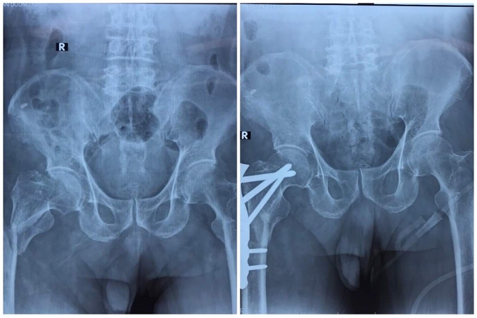 Phẫu thuật thành công cho cụ ông 105 tuổi ngã gãy xương đùi