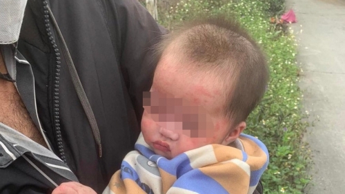 Xót xa bé gái 7 tháng tuổi bị bỏ rơi, trên mặt có nhiều nốt đỏ do muỗi cắn