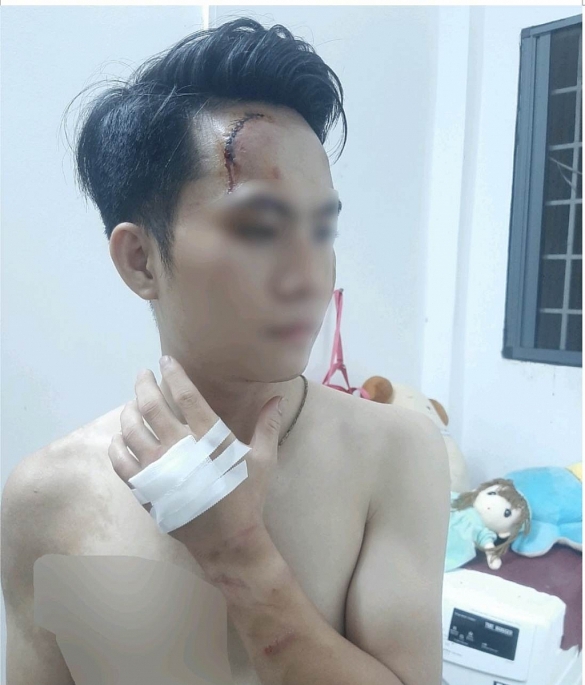 Phóng viên Đ.T bị tổn thương vùng đầu và tay sau khi bị 2 đối tượng lạ hành hung