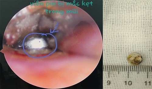 Bé 2 tuổi bị viên “pin cúc áo” gây hoại tử mũi