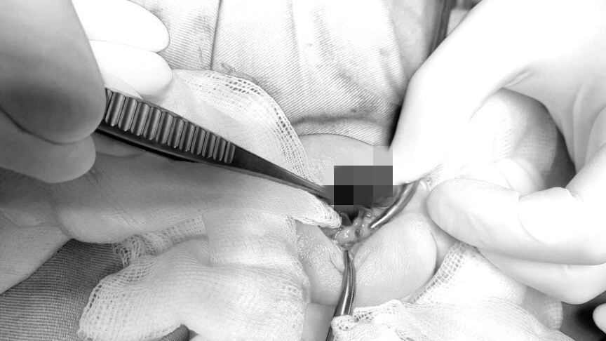 Bệnh lý nguy hiểm khiến bé trai 2 tuổi phải cắt bỏ một bên tinh hoàn