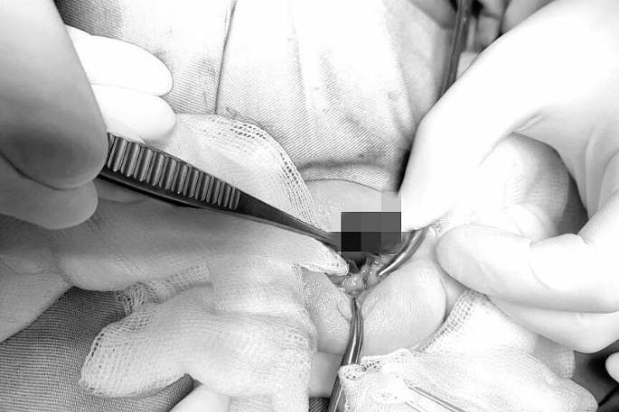 Bệnh lý nguy hiểm khiến bé trai 2 tuổi phải cắt bỏ một bên tinh hoàn