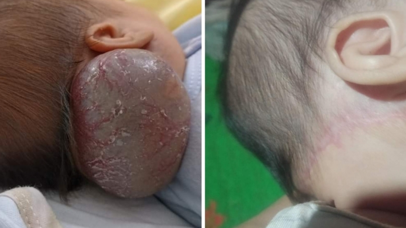 Phẫu thuật thành công cho trẻ sơ sinh 14 ngày tuổi mắc hội chứng Kasabach - Merritt hiếm gặp