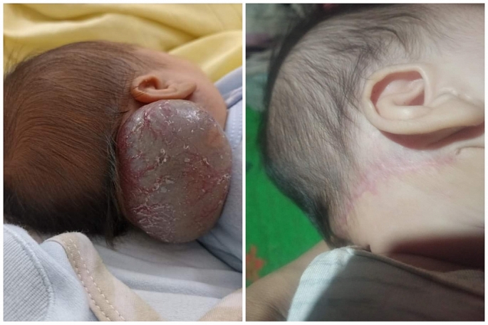 Phẫu thuật thành công cho trẻ sơ sinh 14 ngày tuổi mắc hội chứng Kasabach - Merritt hiếm gặp