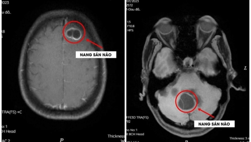 Cẩn trọng với nang sán não do thói quen ăn tiết canh sống