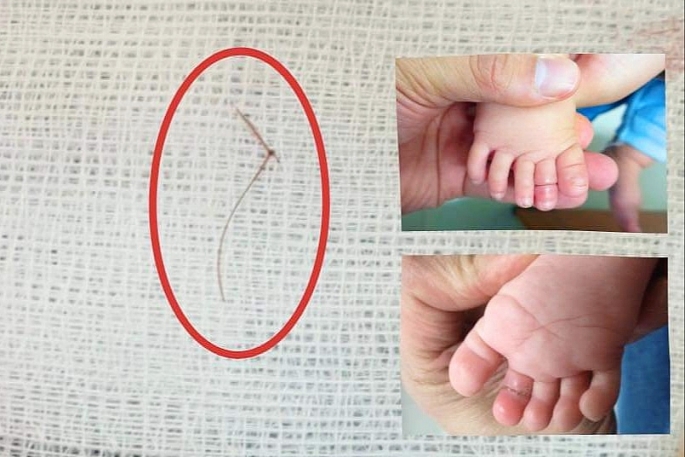 Bé gái suýt mất ngón chân vì sợi tóc