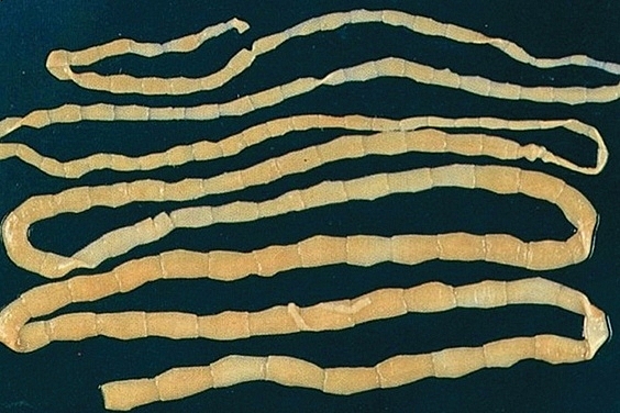 Sán dây dài 10 mét ký sinh trong cơ thể người đàn ông có sở thích ăn đồ sống