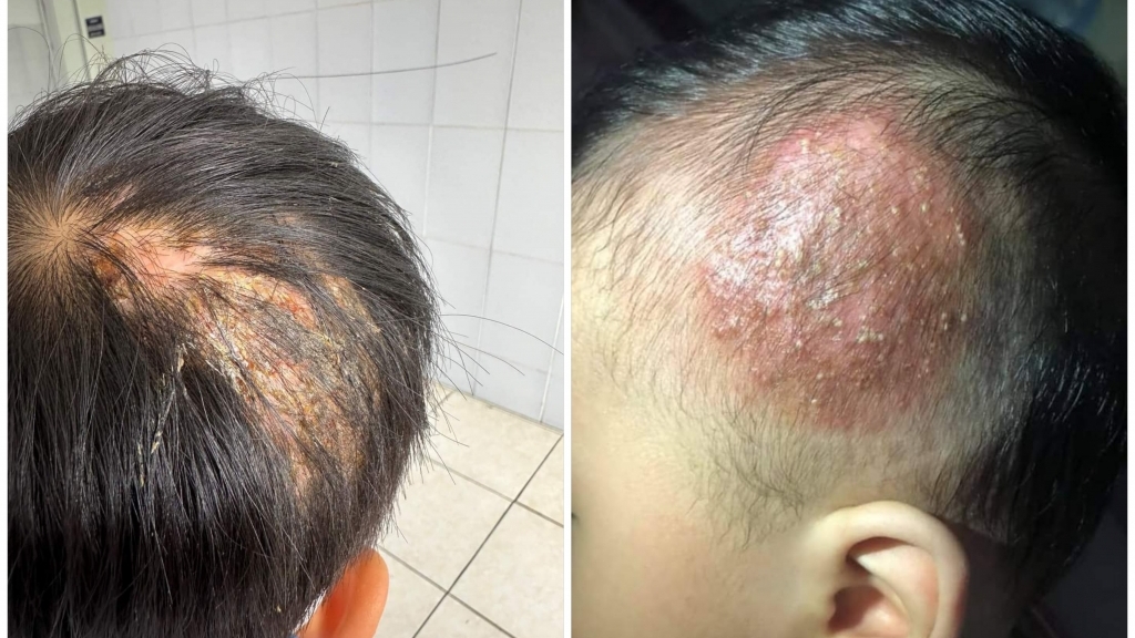 Bé trai 9 tuổi rụng tóc, đầu chảy mủ do căn bệnh lây từ thú cưng