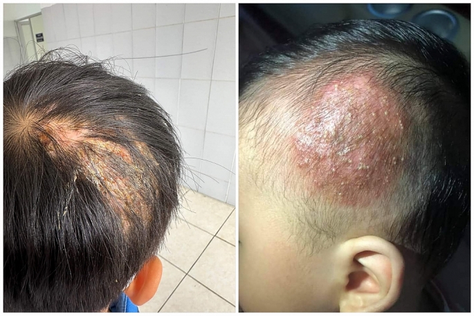 Bé trai 9 tuổi rụng tóc, đầu chảy mủ do căn bệnh lây từ thú cưng