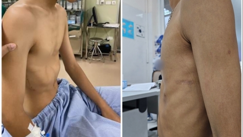 Bệnh nhân 15 tuổi lõm ngực nặng được phẫu thuật cải thiện sức khỏe và ngoại hình