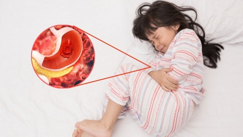 Nhiều trẻ em nhập viện vì xuất huyết tiêu hóa do viêm loét dạ dày tá tràng