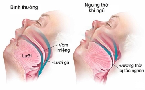 Đường thở ở người bình thường và người có hội chứng ngưng thở khi ngủ.