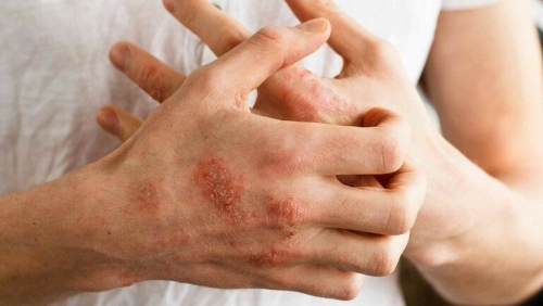 Trẻ bị viêm da cơ địa: nên tránh ăn gì?