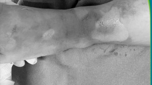 Ăn lẩu tại nhà, ba trẻ nhập viện vì bỏng nặng