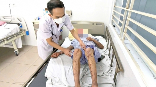 Nước mưa cuốn silicon xuống người, thợ sắt nhập viện trong tình trạng nguy kịch