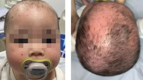 Sai lầm trong chăm sóc khiến bệnh viêm da ở trẻ trở nặng