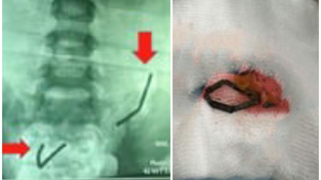 Bé trai 5 tuổi thủng 8 lỗ ở ruột non vì nuốt nam châm