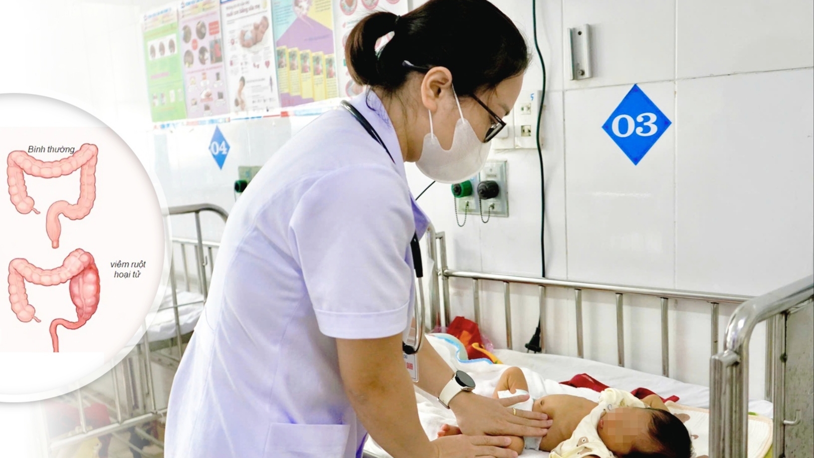 Cứu sống trẻ sinh non 3 ngày tuổi bị viêm ruột hoại tử