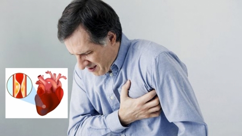 Thoát chết nhờ phát hiện kịp thời nhồi máu cơ tim thầm lặng